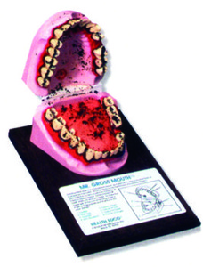 牙齒病理模型(美貨)