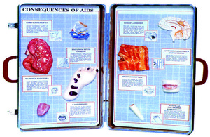 愛滋病的後果展示模型(美貨)