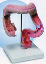 腸胃疾病模型(歐美貨)
